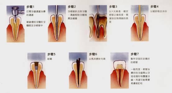 根管治疗是针对牙齿,牙髓,根尖病变的一个治疗过程.